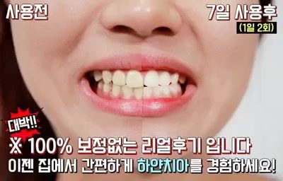 Tosowoong Teeth Whitening glow clinic Features It contains hydrogen peroxide which makes self-tooth whitening effectiveness. This product has fine brushes that apply the contents to all corners of the teeth. It can be used safely. There is no direct damage to the tooth because the foreign material on the teeth reacts with the components of this product. How To Use After brushing the teeth, remove moisture from teeth. Open the cap and turn the bottom part clockwise once until a small amount of ge