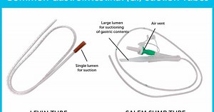 Nasogastric, Feeding tube placement