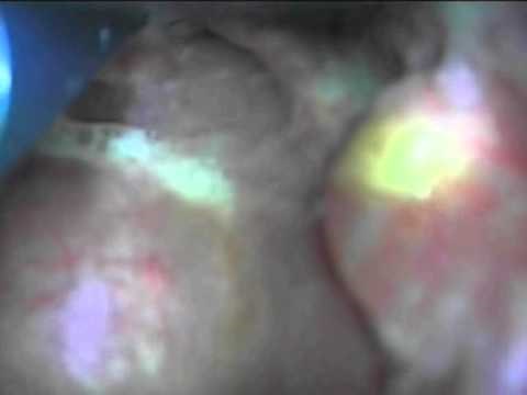 Eight Intubations using the Color GlideScope Video Laryngoscope