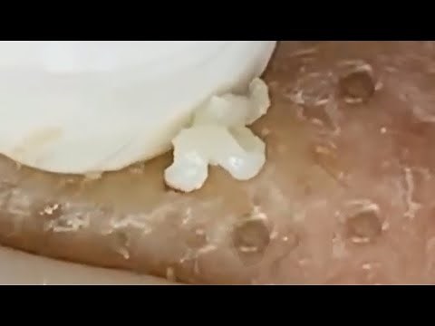 Deep blackhead extraction Cystic acne & pimple popping #72