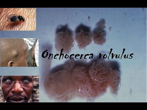 Onchocerca volvulus