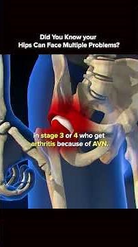 Hip Replacement Surgery for Avascular Necrosis. Stages for AVN.