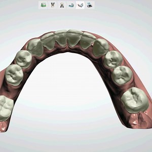 Vidéo de simulation d’un traitement par gouttières transparentes pour fermer un espace dentaire #invisalign #instavideo | Dr.Khaldi Lobna | Facebook