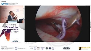 Presentation of the Lasso-loop Intra-articular Biceps Tenodesis: Is This the Easiest Technique?