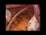 SELS - Laparoscopic Trans-Abdominal Cerclage (LTAC) • Video • MEDtube.net