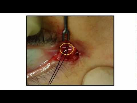 Dr. Kwon Blog #7 Lateral canthus reconstruction procedure and result
