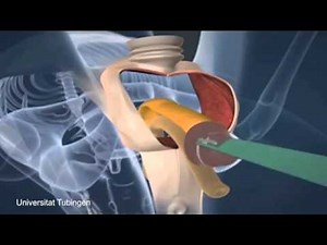 The surgical process for male to female sex reassignment