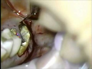 上顎大臼歯の歯冠長延長術 Crown lengthning procedure