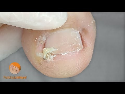 Ingrown toenails from improper trimming | Correction to eliminate discomfort immediately