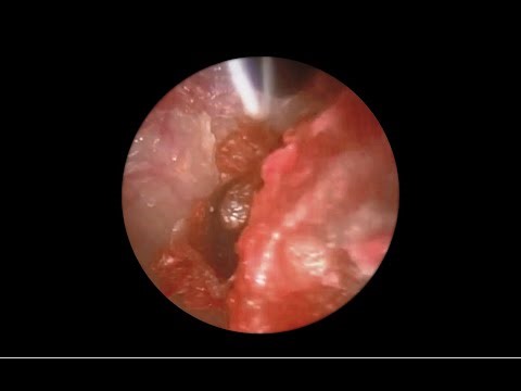 S03E03 - Earwax Removal | Cleaning Dense Blockage Ear Wax Impaction | Solid Ear Wax