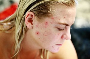 Probiotics an effective alternative to treat acne