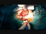 Intraoperative Facial Nerve Monitoring During Parotidectomy • Video • MEDtube.net