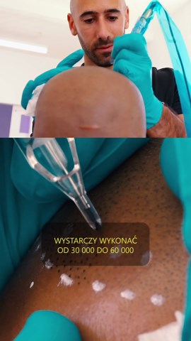 Matt Iulo, Przekształcanie życia dzięki mikropigmentacji skóry głowy