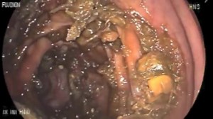 Colon poop and a bad colonoscopy prep follow the directions