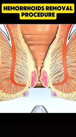Hemorrhoids Removal Procedure Explained