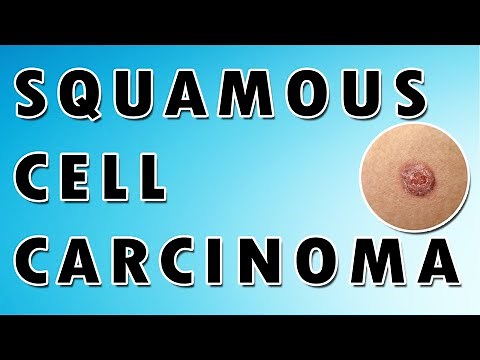 Squamous Cell Carcinoma