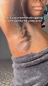 3.9K views · 53 reactions | Comment “HS Warrior” to receive our top tips for soothing those painful flare-ups. | Mymagichealer | Facebook