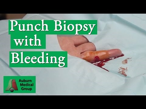Punch Biopsy Bleeding Complication | Auburn Medical Group