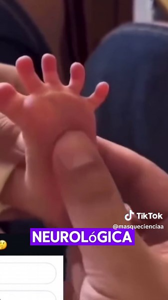 Signo de Babinski en Neonatos: Respuesta Neurológica