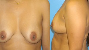 Mommy Makeover Results: The Doctor Shares Before & After Photos