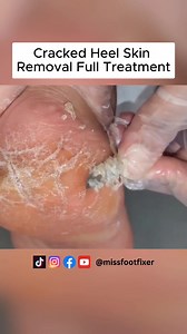 Fix Cracked Feet : Cracked Heel Skin Removal Full Treatment By Miss Foot Fixer. #crackedheels #missfootfixer #crackedheelremoval | Miss Foot Fixer