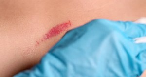 Cleaning of the wound form nurse