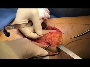 Groin lymph node removal