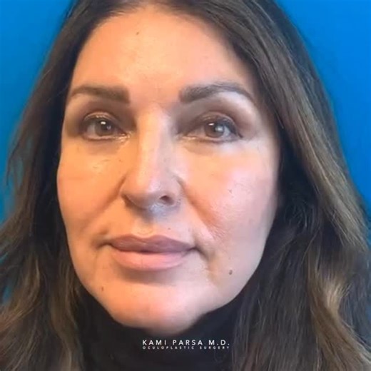 This beautiful patient came to us with complaints of looking tired all the time due to heavy upper eyelids and puffy under eyes. We performed our signature #QuadfectaLift to rejuvenate her eyes. Quadfecta Lift consists of⁣ ☑️Upper eyelid blepharoplasty⁣ ☑️Lower eyelid blepharoplasty⁣ ☑️Fat transfer to mid-face⁣ ☑️Skin tightening⁣ It’s been a pleasure taking care of her. ⁣⁣⁣ For questions on pricing and appointments text us at 310.777.8880 ⁣⁣⁣or follow the link in our profile 🙏❤️ _⁣⁣⁣⁣⁣ 📱 Phone