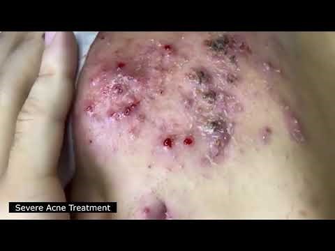 BEST BLACKHEAD AND WHITEHEAD REMOVAL! SEVERE ACNE TREATMENT - SATISFYING AND RELAXING VIDEO