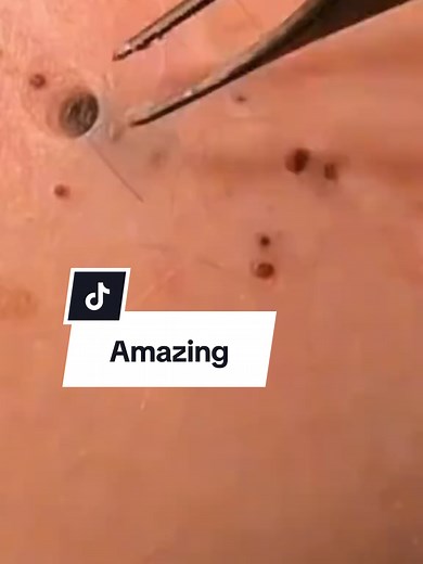 Amazing Blackhead Removal Supersatisfying