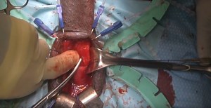 Inflatable penile prosthesis and mini male sling | Urology Times