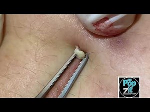 10 minutes of close up extractions. Blackheads, whiteheads, follicular cysts, ingrown hairs. pops