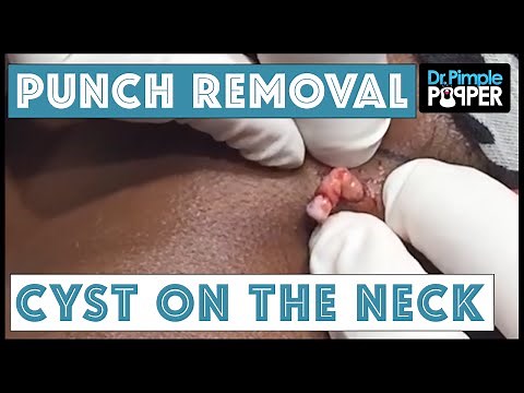 A Cyst Removed on the Left Neck Via Punch Biopsy Tool