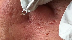 Blackheads Removal | Medical Dirty