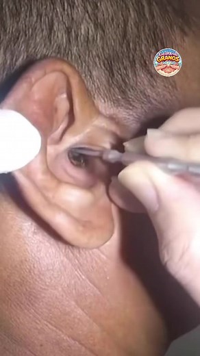EAR POP…#pimples #blackheads #relaxing #music #granos