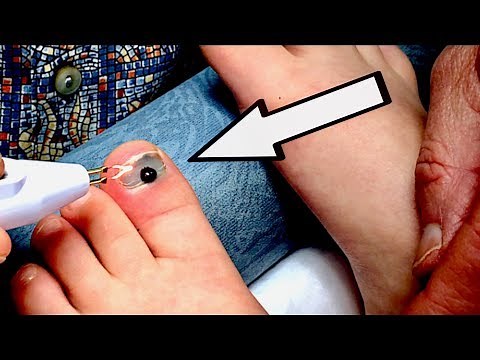 BURNING A HOLE THROUGH A TOENAIL (with blood trapped under it) | Dr. Paul