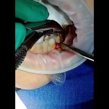 Cowhorn Removal of a Molar