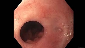 Check out this clip from Safe Application of Topical Mitomycin C for Treatment of Refractory Anastomotic Stenosis and visit GI Leap for all ASGE videos from DDW 2020! http://ow.ly/Vdpr50DleT5 #GIEndoscopy #GITwitter | American Society for Gastrointestinal Endoscopy - ASGE