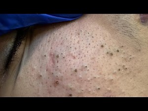 SATISFYING Whitehead Removal & Blackhead Extraction | Best Pimple Popping Techniques