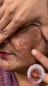 756K views · 2.2K reactions | ✨ Instant Skin Brightening & Pigmentation Removal Mix! #skincare #glowingskin #darkspots #pigmentation #skincareroutine #beautyhacks #naturalremedy #reels | YourBeauty Tv | Facebook