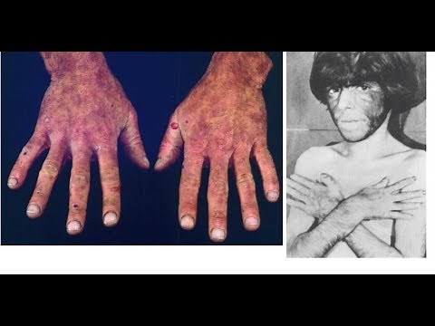 What is Porphyria? Causes, Signs and Symptoms of Porphyrias