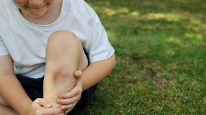 Why do some people bruise easily?