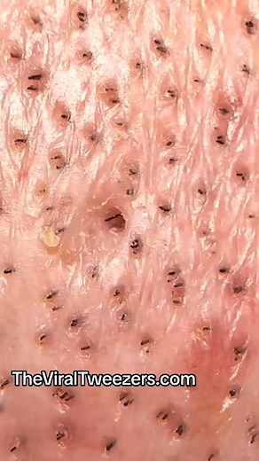 Exploring a scalp with the viral tweezers. #skincare #skincareroutine... | Delarouxskincare