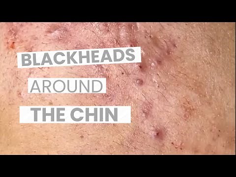 Chin Pimple Extraction - The Most Satisfying Acne & Pimple Videos
