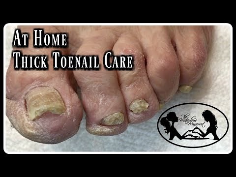 Pedicure At Home Elderly Toenails Cutting Thick Toenails and Nail Fungus