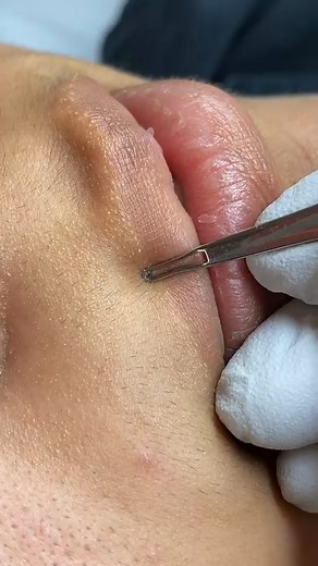 Extractions satisfaction | How To Make