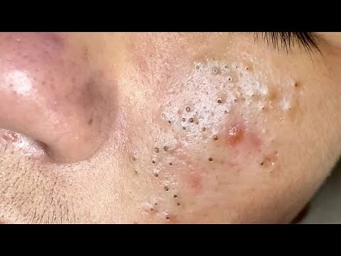 Suri Job #639: Great Inflamed Acne Extraction