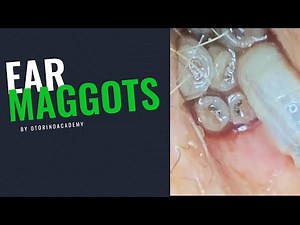 EAR MAGGOTS (COMPLETE VIDEO - FULL TREATMENT)