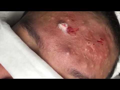 Under Skin Severe Acne Removal On Face
