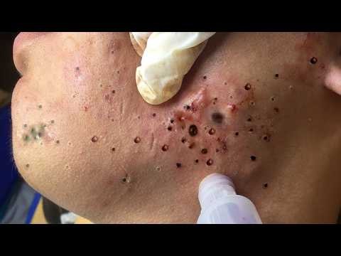 Giant Cystic Acne Removal 😳 Satisfying Extraction Compilation